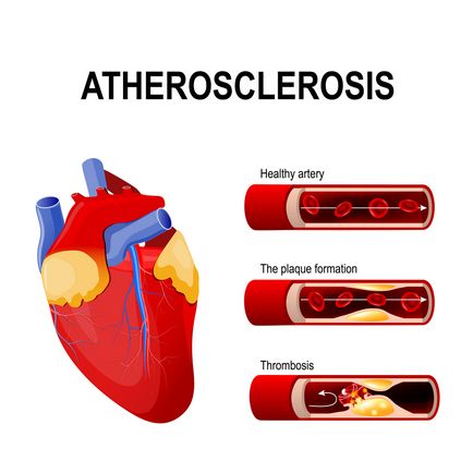 Cauzele infarct miocardic și simptome