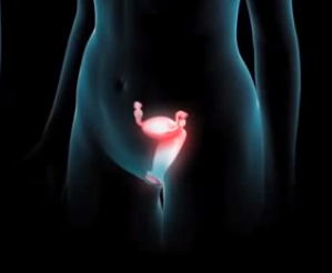 De col uterin infectare - cauze, simptome și tratament