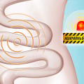 De col uterin infectare - cauze, simptome și tratament