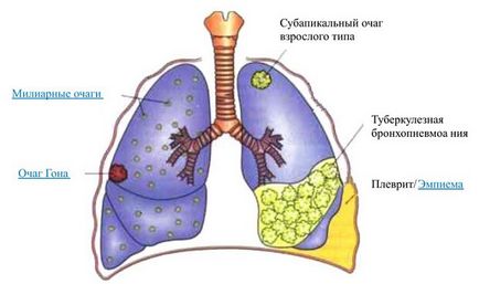 Cum rănit plămânii simptomele față în timpul inhalării la om, tuse