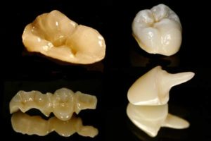 Care sunt filele de pe dinții și ceea ce fac ei