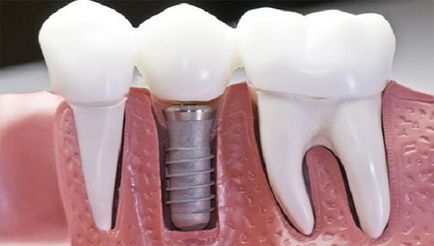 Care sunt dinții introduse - fie pentru a insera dintii rănit și cât de mult costă - portal stomatologic