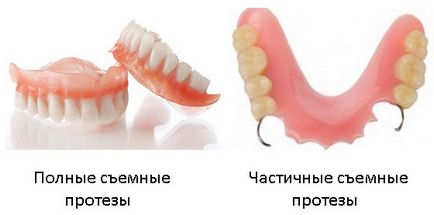 Care sunt dinții introduse - fie pentru a insera dintii rănit și cât de mult costă - portal stomatologic