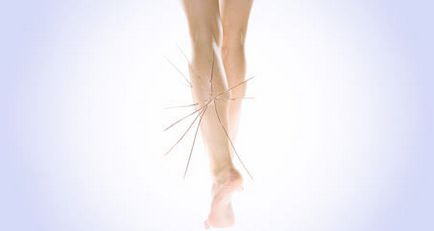 Cum sa scapi de vascularizația pe picioare 5 sfaturi
