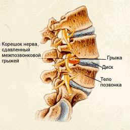 Cum de a trata o hernie spinarii, si daca poti face singur