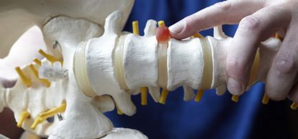 Cum de a trata o coloană vertebrală cervicală și lombară hernie
