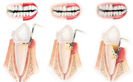 Cum de a trata simptomele bolii parodontale si prevenirea bolilor