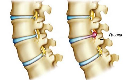 Cum de a trata o hernie remedii populare la domiciliu