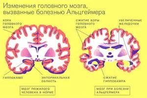 Deoarece măduva spinării este formată de substanța cenușie a bulbului rahidian și secundar, în cazul în care este în același timp