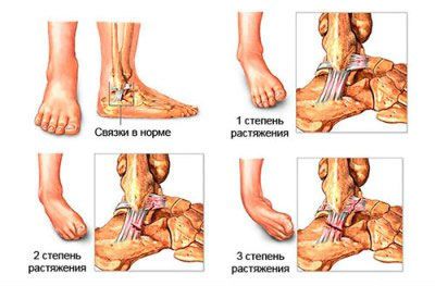 Pe măsură ce tratamentul se întinde este efectuat ligamente și remedii populare