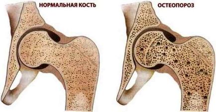 Cum de a trata osteoporoza remedii populare la domiciliu