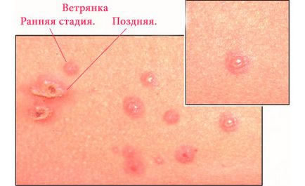 Care sunt simptomele de varicela la copii si adulti cu simptome de fotografii