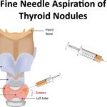 Cum sunt ganglionii limfatici si tiroida