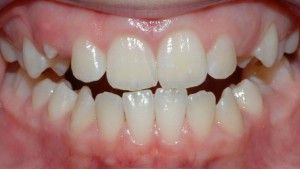 Cum de a consolida smalțul dinților acasă căi de atac populare