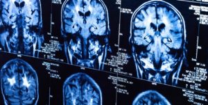 Ce este scleroza multiplă pe RMN, cauzele si simptomele bolii