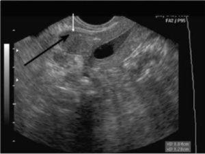 uterin calcificat fibroamelor particularități de tratament și de dezvoltare