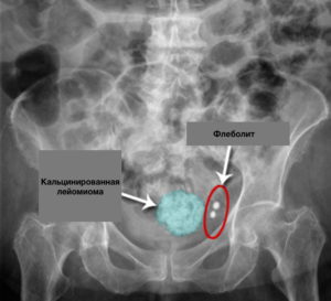 uterin calcificat fibroamelor particularități de tratament și de dezvoltare