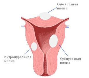 uterin calcificat fibroamelor particularități de tratament și de dezvoltare