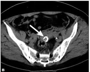 uterin calcificat fibroamelor particularități de tratament și de dezvoltare