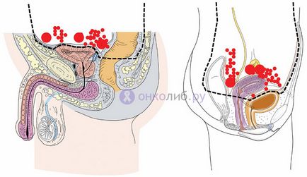 carcinomatoza peritoneala (cavitatea abdominală), plămân - tratament, prognostic