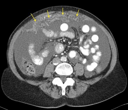 carcinomatoza peritoneala (cavitatea abdominală), plămân - tratament, prognostic