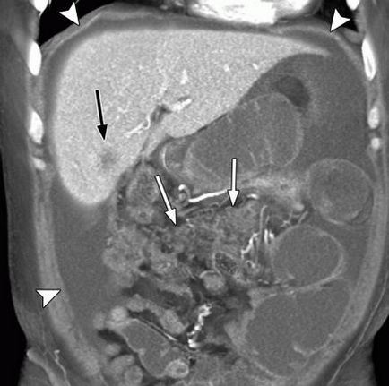 simptome carcinomatoza peritoneala, prognostic, tratament