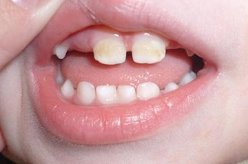 cariilor dentare lapte - primele semne și metode de tratament