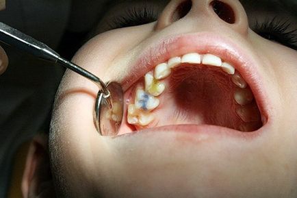 cariilor dentare lapte - primele semne și metode de tratament