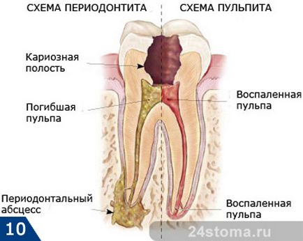 Cariile dentare - foto, cauze, consecințe