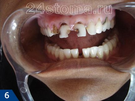 Cariile dentare - foto, cauze, consecințe