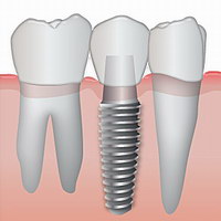 implanturi dentare complete - dinti in 4 zile!