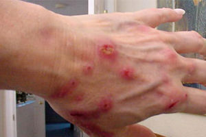 Contact simptome dermatită și tratament cauzează dermatita de contact, mijloace eficiente atunci când