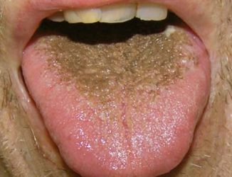 Pete maronii pe limba la adulți cauze și tratament