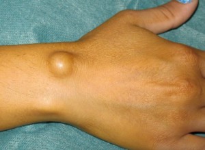 Bone la încheietura mâinii pe partea exterioară a cauze, simptome, metode de diagnostic și tratament