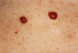 Sunt cauze birthmark roșii, periculoase, tratarea și eliminarea copiilor și adulților, ABC