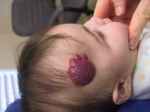 Sunt cauze birthmark roșii, periculoase, tratarea și eliminarea copiilor și adulților, ABC