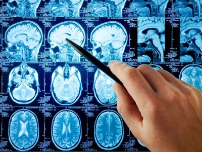 infarct lacunar (accident vascular cerebral) a creierului ceea ce este, ceea ce consecințele