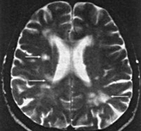 infarct cerebral lacunar - cauze, simptome, diagnostic și tratament