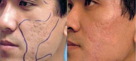 Tratament cu laser pentru acnee caracteristici, beneficii și proceduri de preț