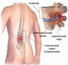 exercițiu terapeutic exerciții coloanei vertebrale lombare hernie, videoclipuri, fotografii