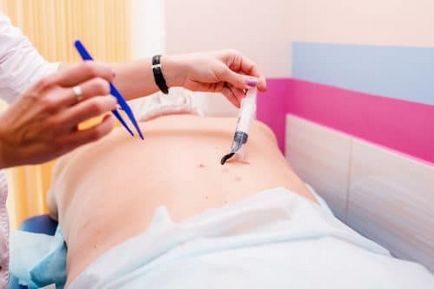 Tratamentul endometritei de remedii populare