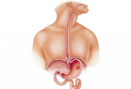 Tratamentul herniei esofagian de beneficii remedii populare