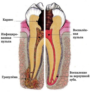 Tratamentul de canal radicular, curățarea și umplerea canalelor și rădăcinile dinților