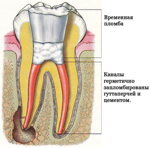 Tratamentul de canal radicular, curățarea și umplerea canalelor și rădăcinile dinților