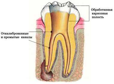 Tratamentul de canal radicular, curățarea și umplerea canalelor și rădăcinile dinților