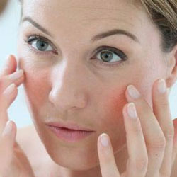 remedii populare acnee rozacee tratament la domiciliu