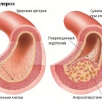 remedii populare Tratamentul arterioscleroza membrelor inferioare