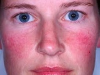Tratamentul de acnee rozacee pe fața de atac folk, medicina tradițională