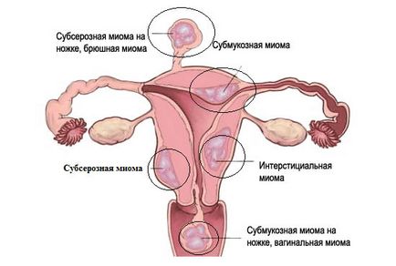 Tratamentul pe bază de plante de fibrom uterin, medicina populara pentru fibrom, rețete