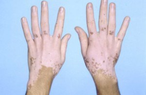 Tratamentul de vitiligo cu remedii populare